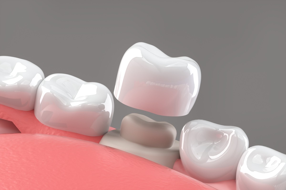 Protect your tooth with dental crown replacement in Palm Desert, CA
